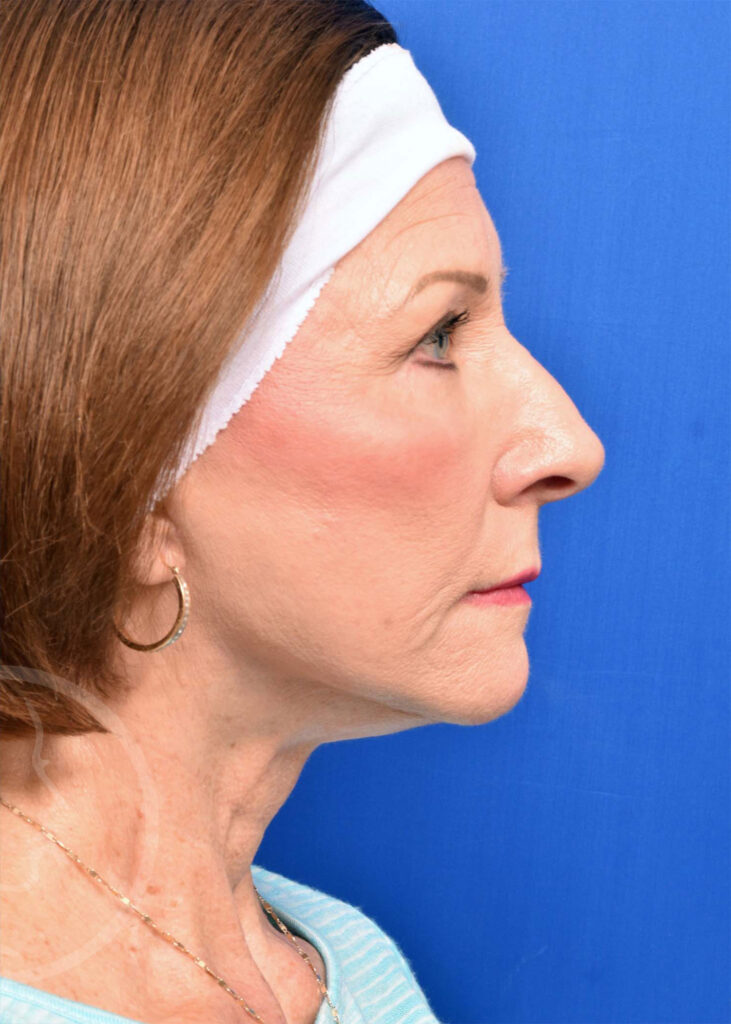 Facelift Before and After Pictures Jacksonville, FL