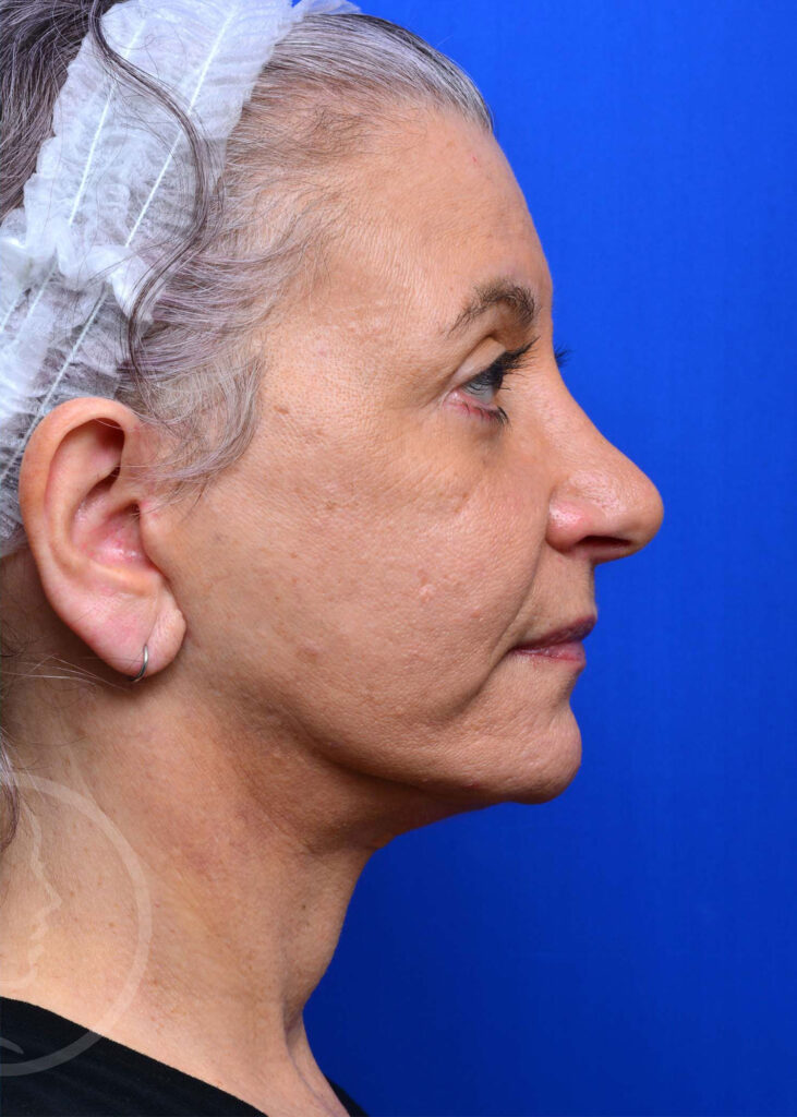 Facelift Before and After Pictures Jacksonville, FL