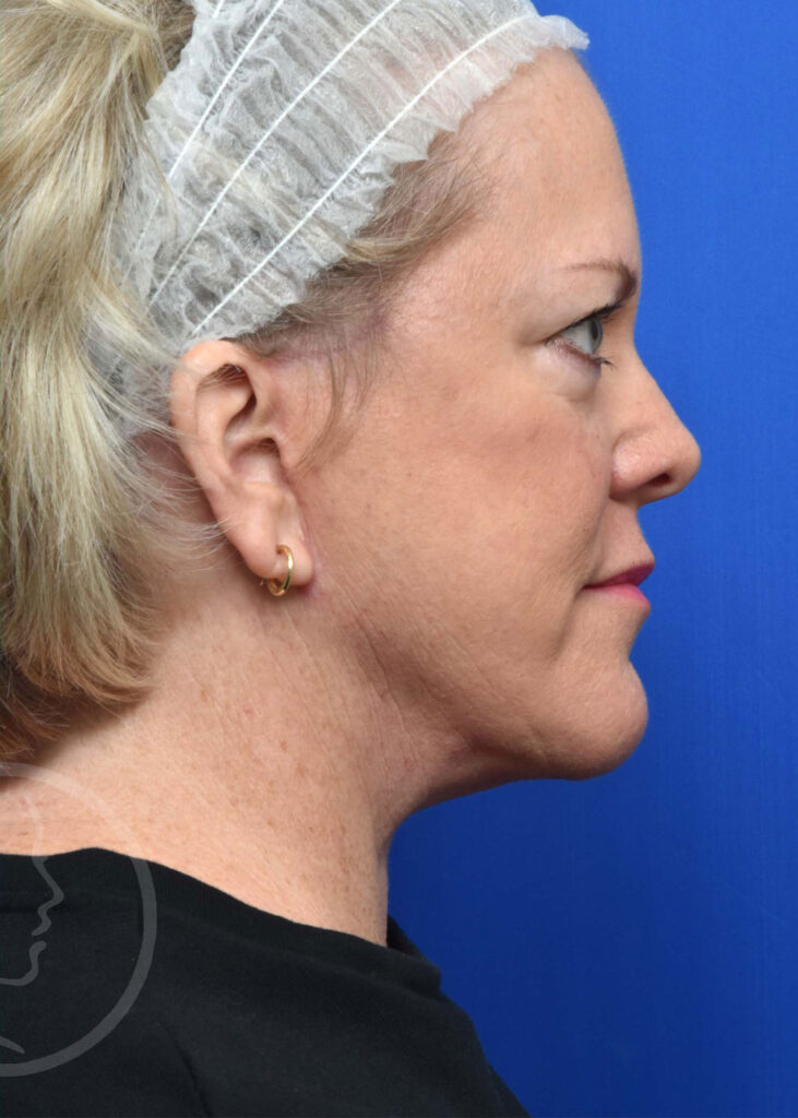 Facelift Before and After Pictures Jacksonville, FL