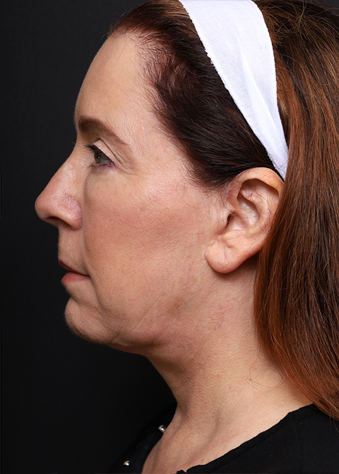 Plastic Surgery Before and After Pictures in Jacksonville, FL - Garcia Facial Plastic Surgery