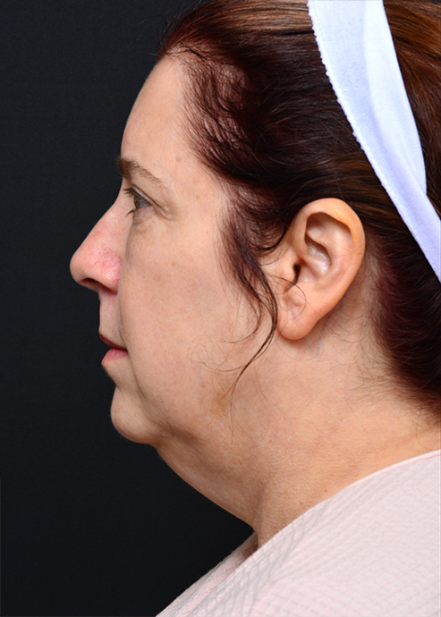 Plastic Surgery Before and After Pictures in Jacksonville, FL - Garcia Facial Plastic Surgery