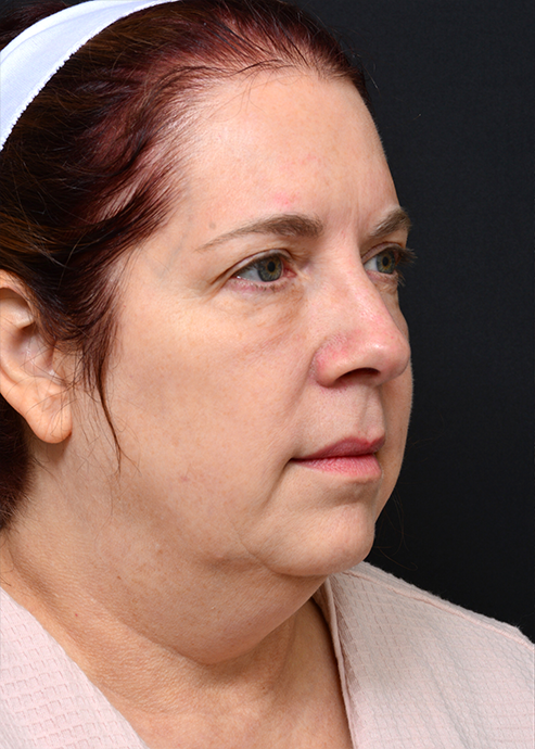 Plastic Surgery Before and After Pictures in Jacksonville, FL - Garcia Facial Plastic Surgery
