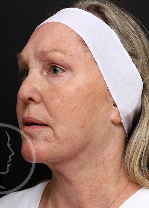Plastic Surgery Before and After Pictures in Jacksonville, FL - Garcia Facial Plastic Surgery
