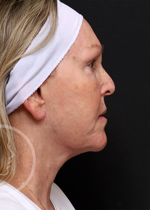 Plastic Surgery Before and After Pictures in Jacksonville, FL - Garcia Facial Plastic Surgery