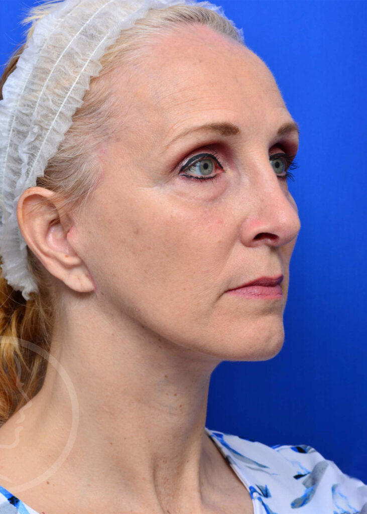 Facelift Before and After Pictures Jacksonville, FL