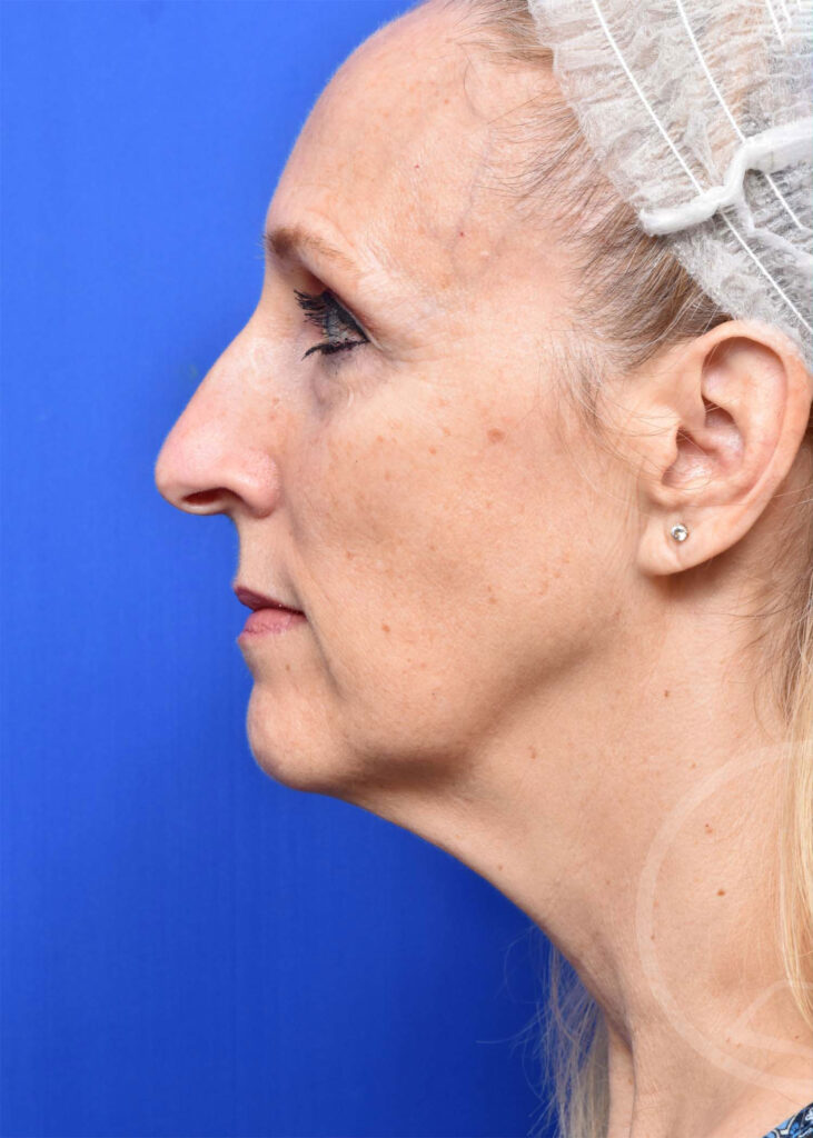 Facelift Before and After Pictures Jacksonville, FL