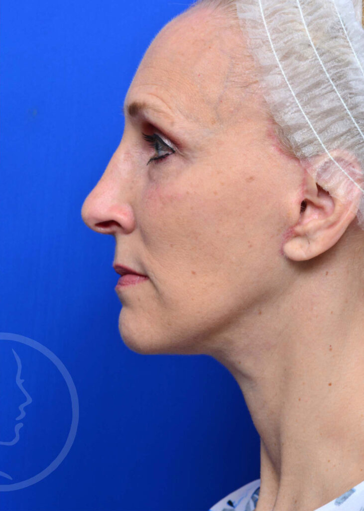 Facelift Before and After Pictures Jacksonville, FL