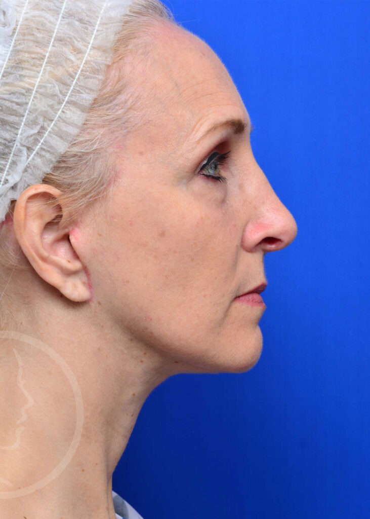 Facelift Before and After Pictures Jacksonville, FL