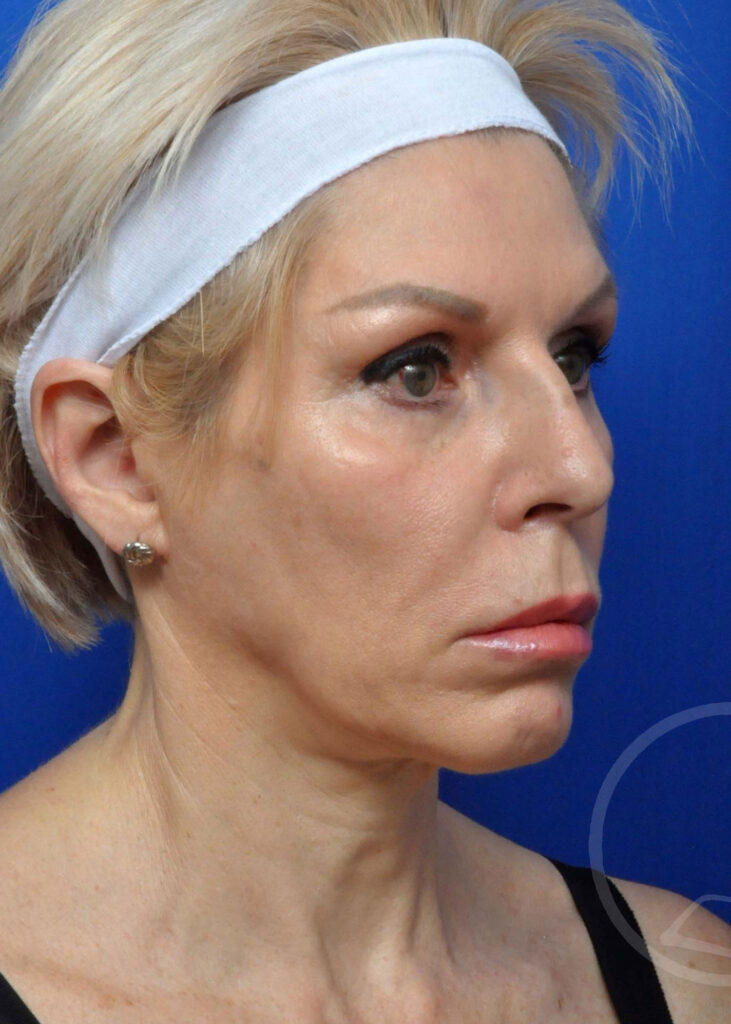 Facelift Before and After Pictures Jacksonville, FL