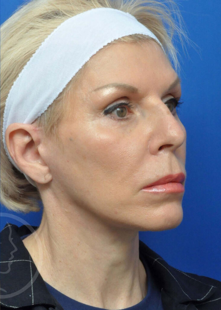 Facelift Before and After Pictures Jacksonville, FL