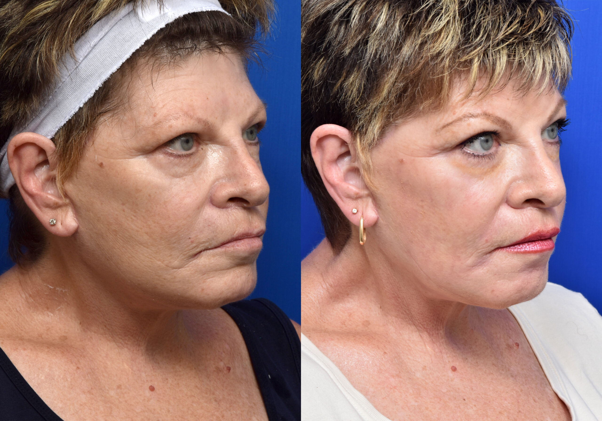 This patient received the Hybrid Fractional Laser Peel.