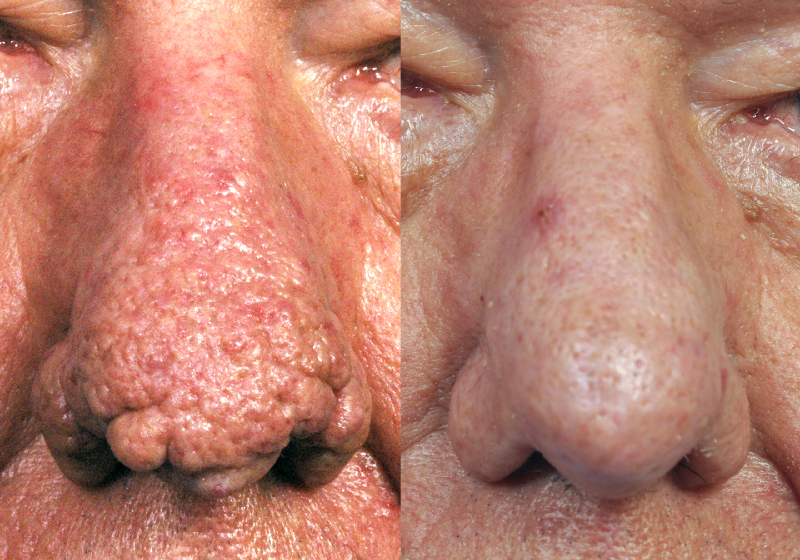 This patient received Dermabrasion to smooth the texture of his nose.