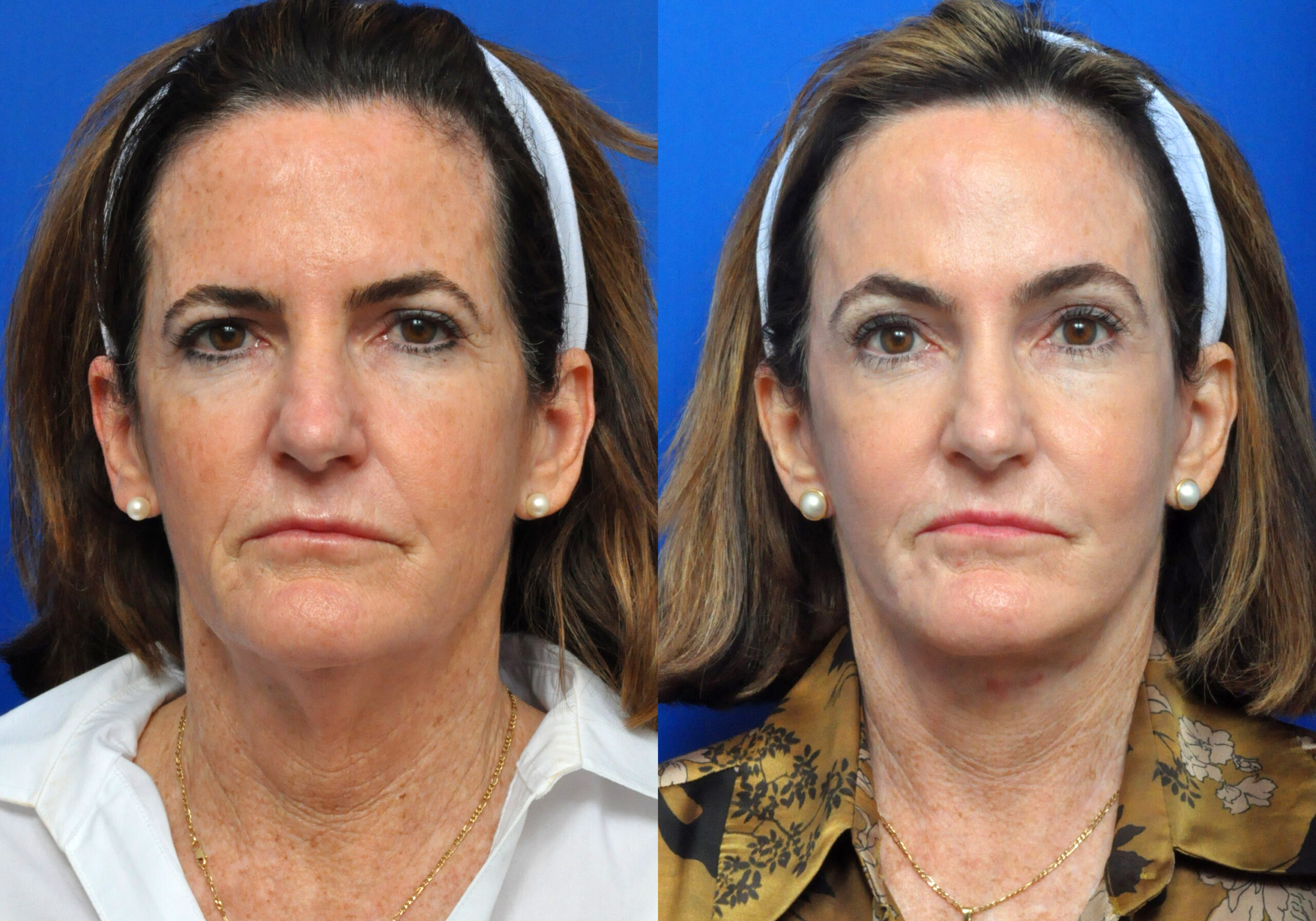 This patient received a Full Face Chemical Peel to help even her skin tone, along with her facelift, neck lift, brow lift, and fat grafting procedure.