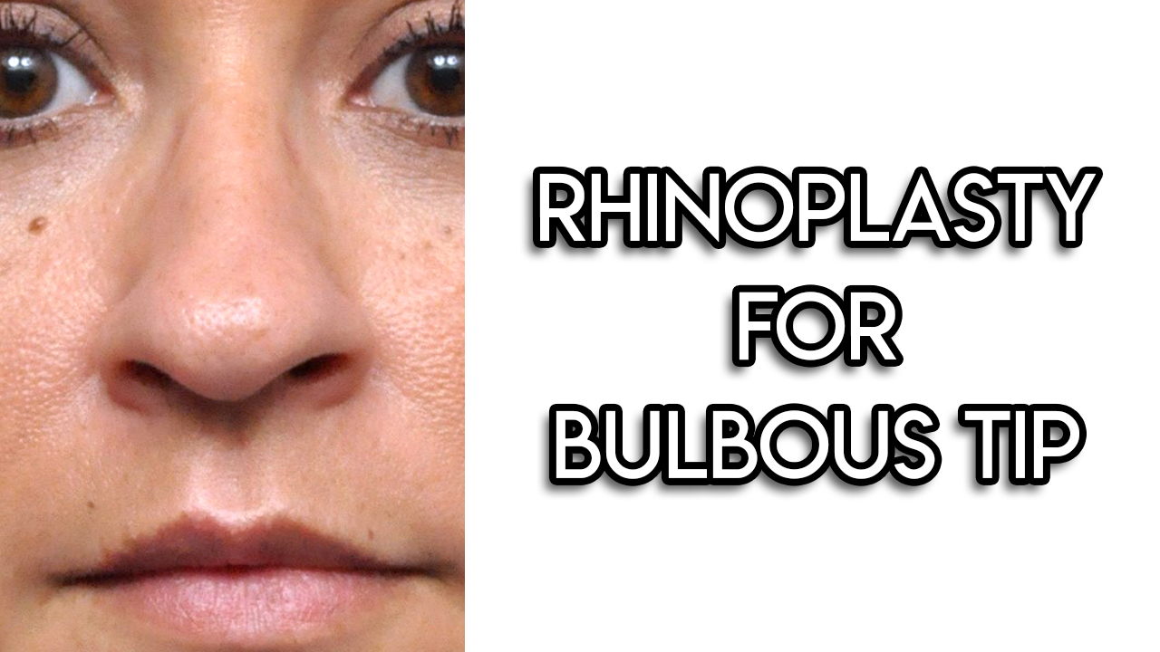 Rhinoplasty for Bulbous Tip