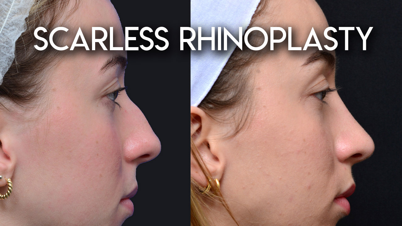 Scarless Rhinoplasty