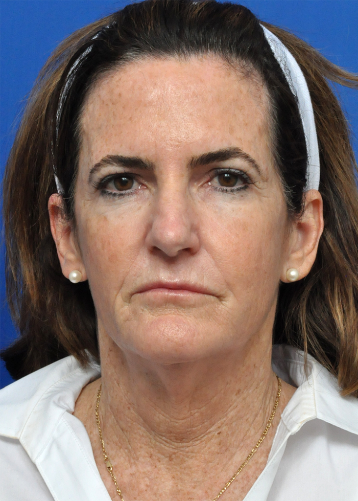 Plastic Surgery Before and After Pictures in Jacksonville, FL - Garcia Facial Plastic Surgery