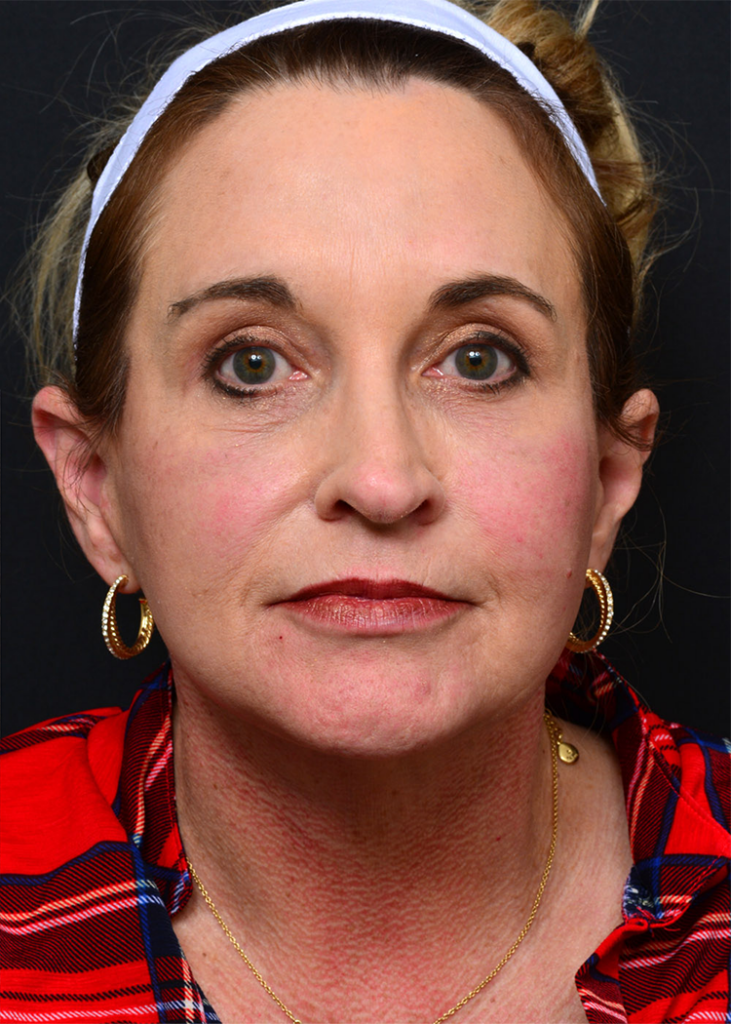 Plastic Surgery Before and After Pictures in Jacksonville, FL - Garcia Facial Plastic Surgery