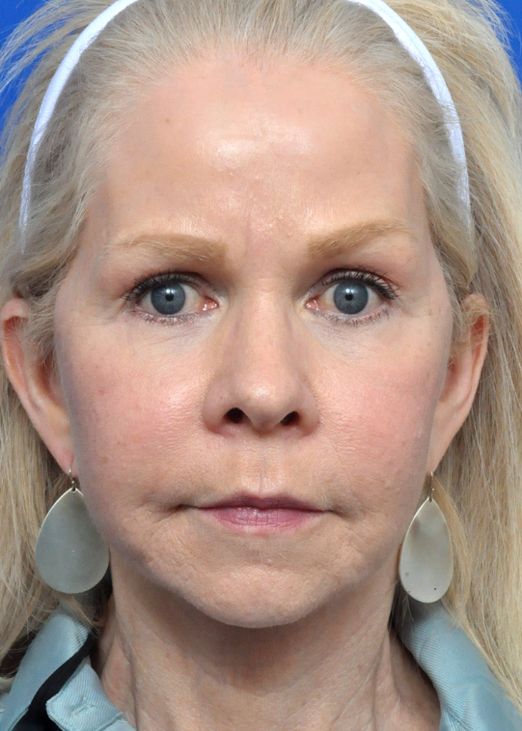 Plastic Surgery Before and After Pictures in Jacksonville, FL - Garcia Facial Plastic Surgery