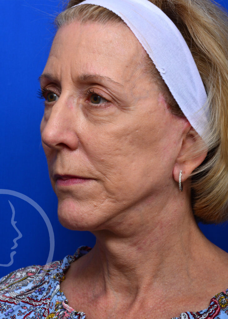 Plastic Surgery Before and After Pictures in Jacksonville, FL - Garcia Facial Plastic Surgery