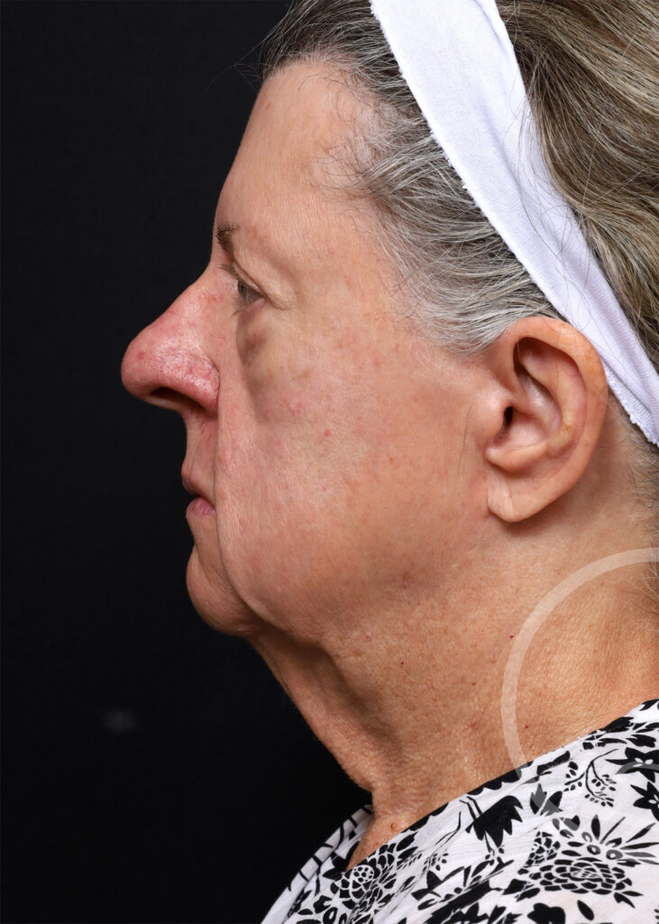Plastic Surgery Before and After Pictures in Jacksonville, FL - Garcia Facial Plastic Surgery