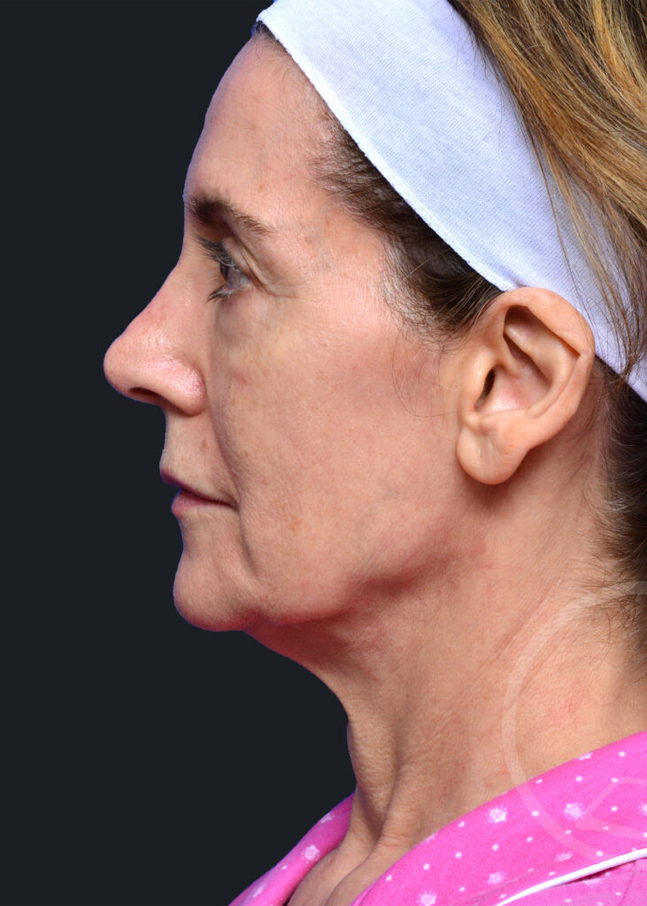 Plastic Surgery Before and After Pictures in Jacksonville, FL - Garcia Facial Plastic Surgery