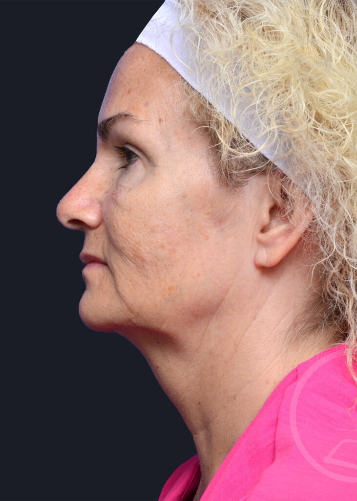 Plastic Surgery Before and After Pictures in Jacksonville, FL - Garcia Facial Plastic Surgery