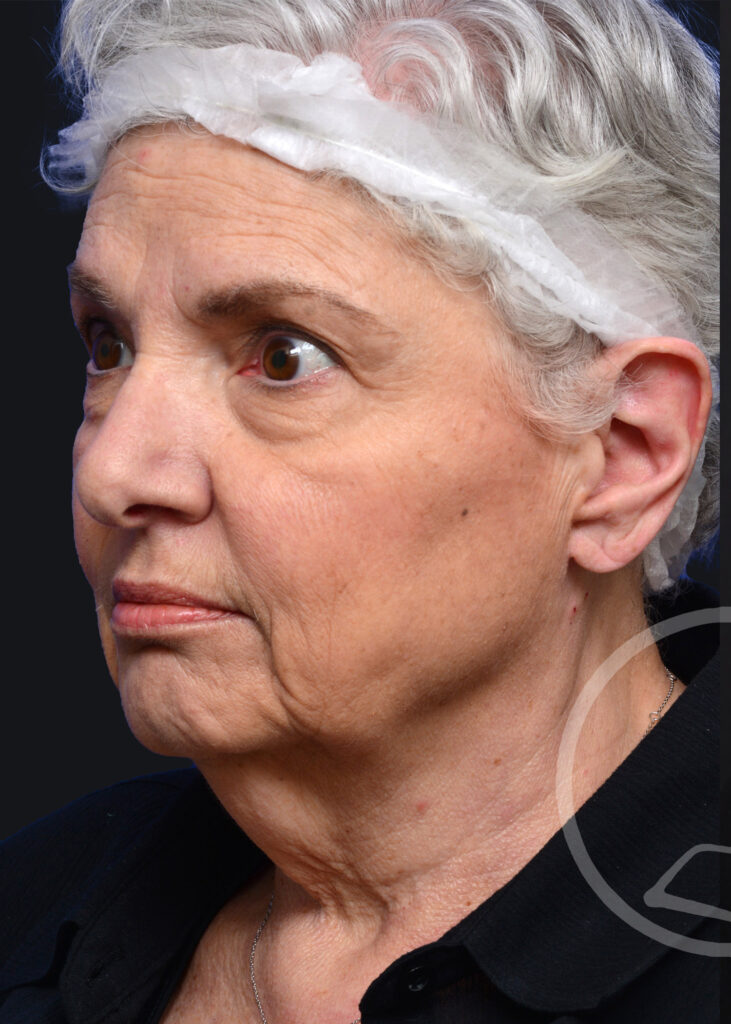 Plastic Surgery Before and After Pictures in Jacksonville, FL - Garcia Facial Plastic Surgery