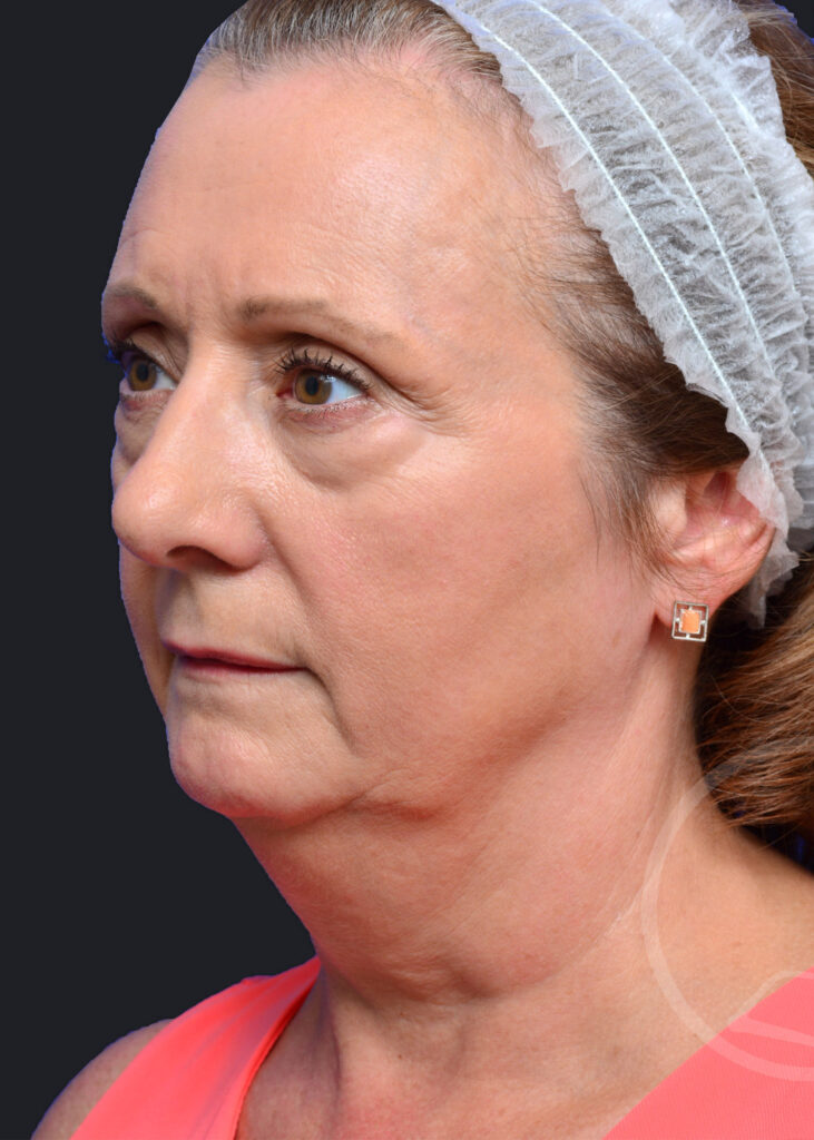 Plastic Surgery Before and After Pictures in Jacksonville, FL - Garcia Facial Plastic Surgery