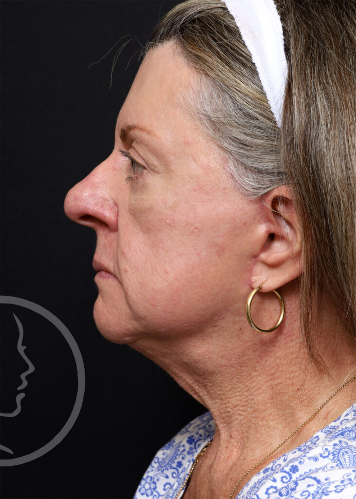 Plastic Surgery Before and After Pictures in Jacksonville, FL - Garcia Facial Plastic Surgery