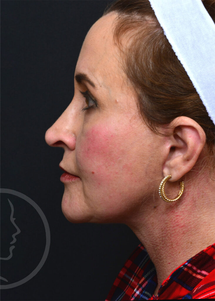 Plastic Surgery Before and After Pictures in Jacksonville, FL - Garcia Facial Plastic Surgery