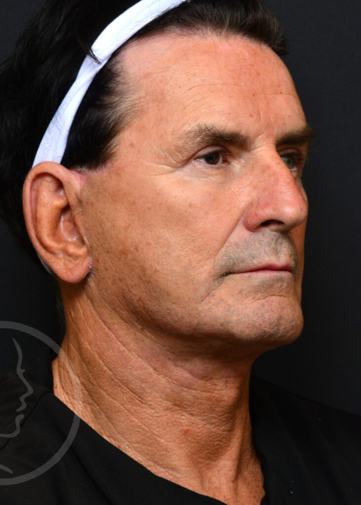 Plastic Surgery Before and After Pictures in Jacksonville, FL - Garcia Facial Plastic Surgery