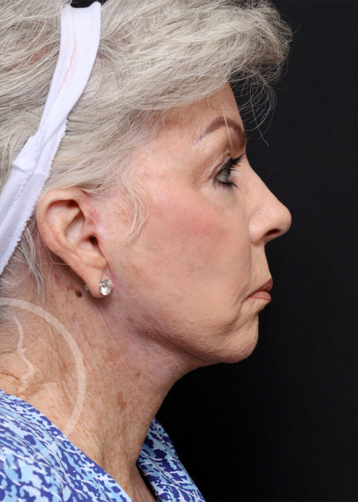 Plastic Surgery Before and After Pictures in Jacksonville, FL - Garcia Facial Plastic Surgery