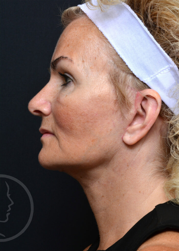 Plastic Surgery Before and After Pictures in Jacksonville, FL - Garcia Facial Plastic Surgery