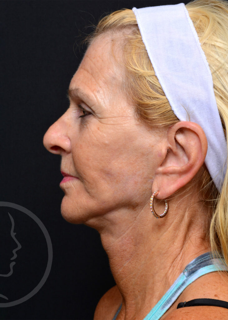Plastic Surgery Before and After Pictures in Jacksonville, FL - Garcia Facial Plastic Surgery