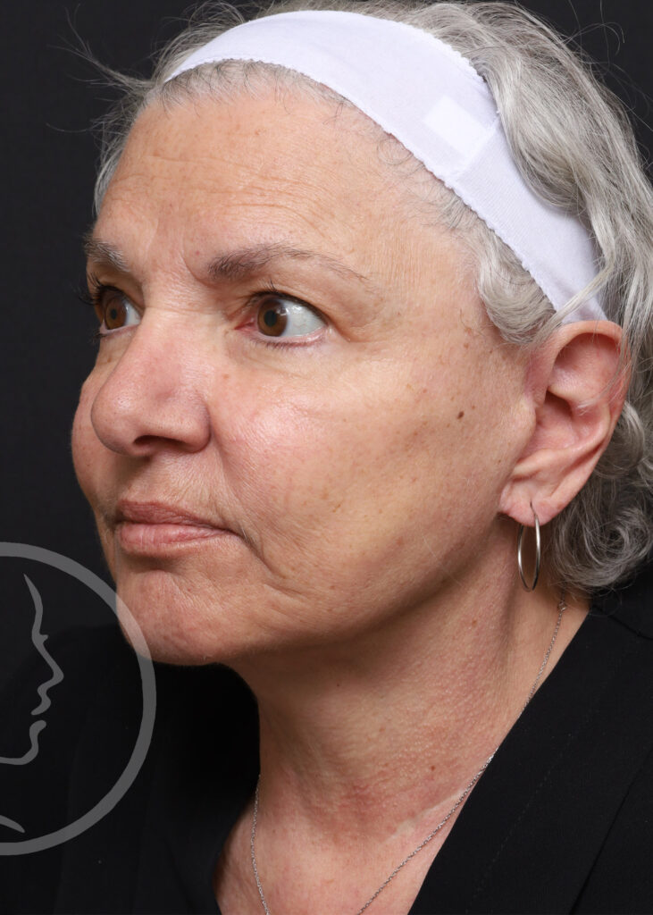 Plastic Surgery Before and After Pictures in Jacksonville, FL - Garcia Facial Plastic Surgery