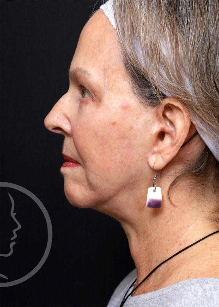 Plastic Surgery Before and After Pictures in Jacksonville, FL - Garcia Facial Plastic Surgery