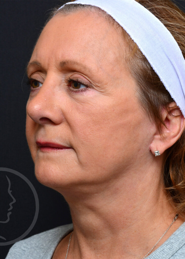 Plastic Surgery Before and After Pictures in Jacksonville, FL - Garcia Facial Plastic Surgery