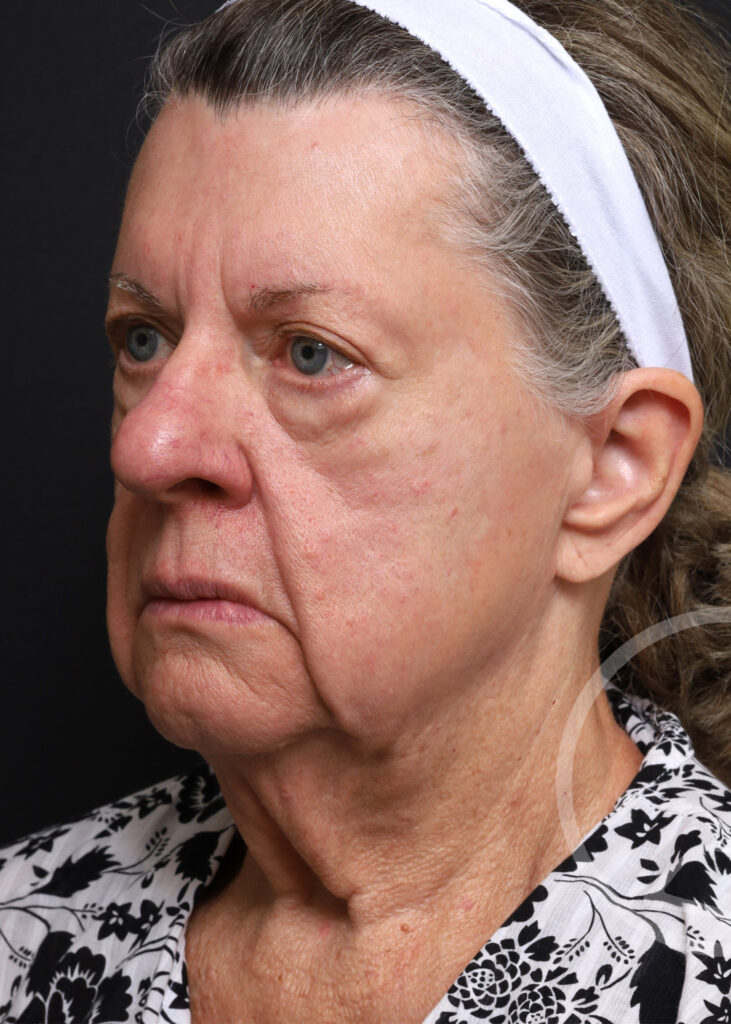 Plastic Surgery Before and After Pictures in Jacksonville, FL - Garcia Facial Plastic Surgery