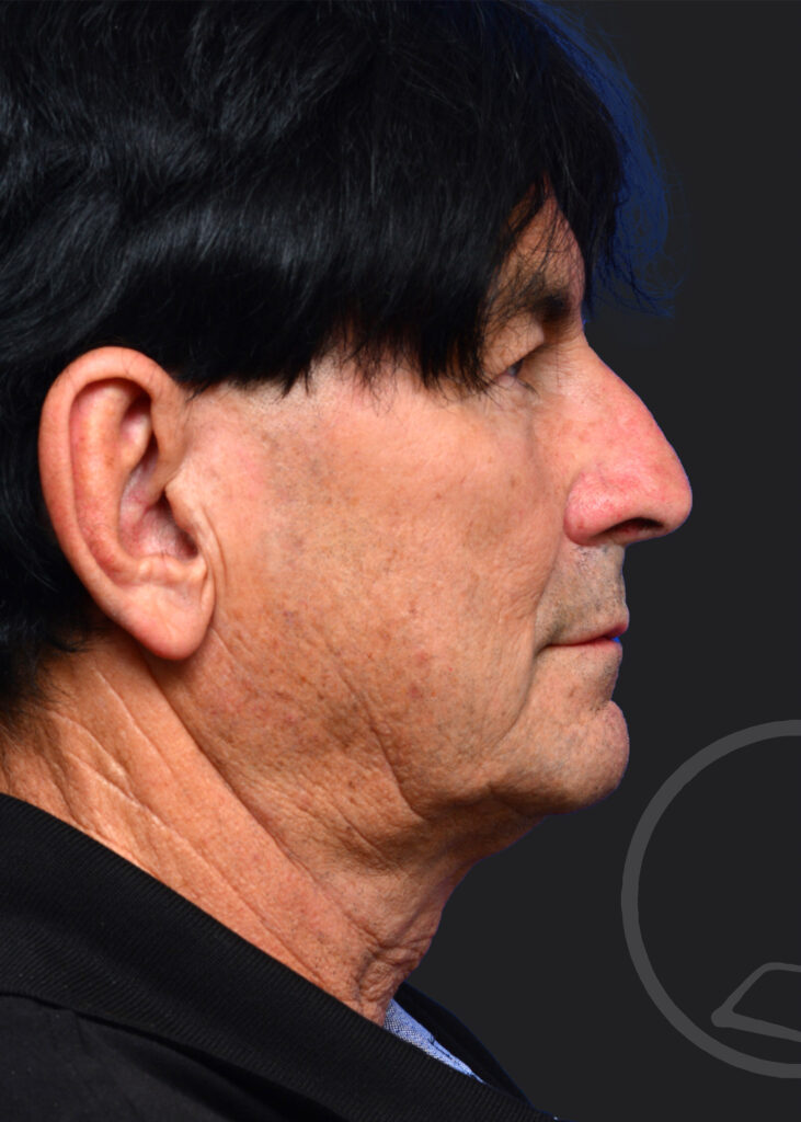 Plastic Surgery Before and After Pictures in Jacksonville, FL - Garcia Facial Plastic Surgery