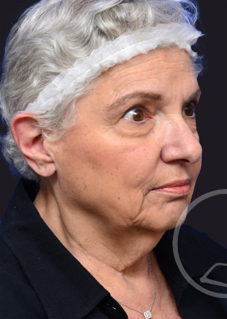 Plastic Surgery Before and After Pictures in Jacksonville, FL - Garcia Facial Plastic Surgery