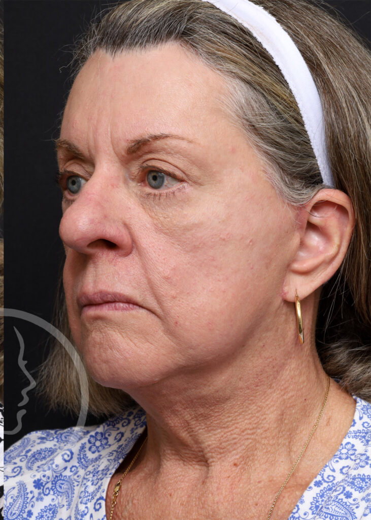Plastic Surgery Before and After Pictures in Jacksonville, FL - Garcia Facial Plastic Surgery