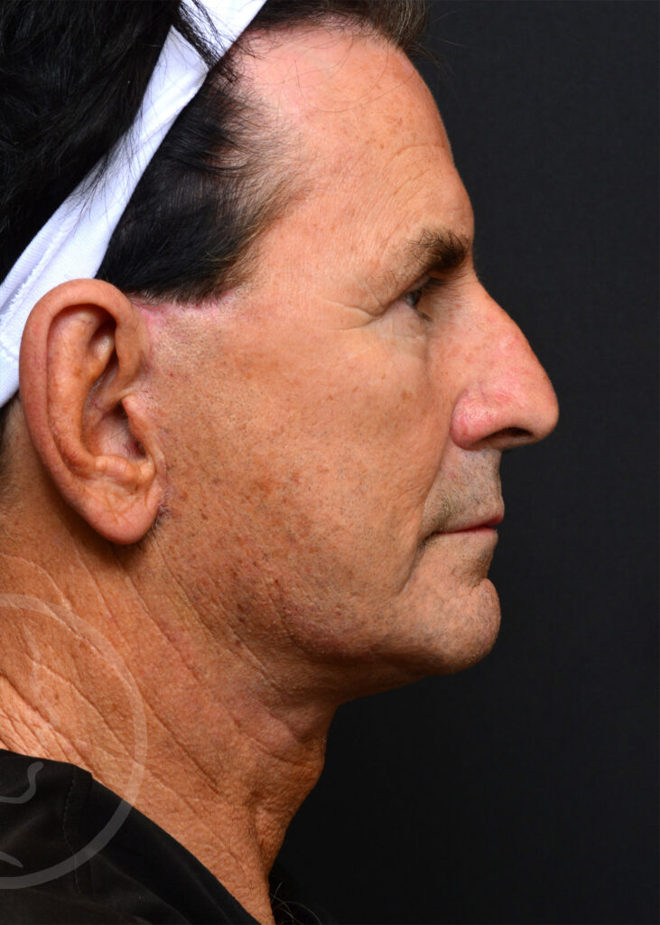 Plastic Surgery Before and After Pictures in Jacksonville, FL - Garcia Facial Plastic Surgery