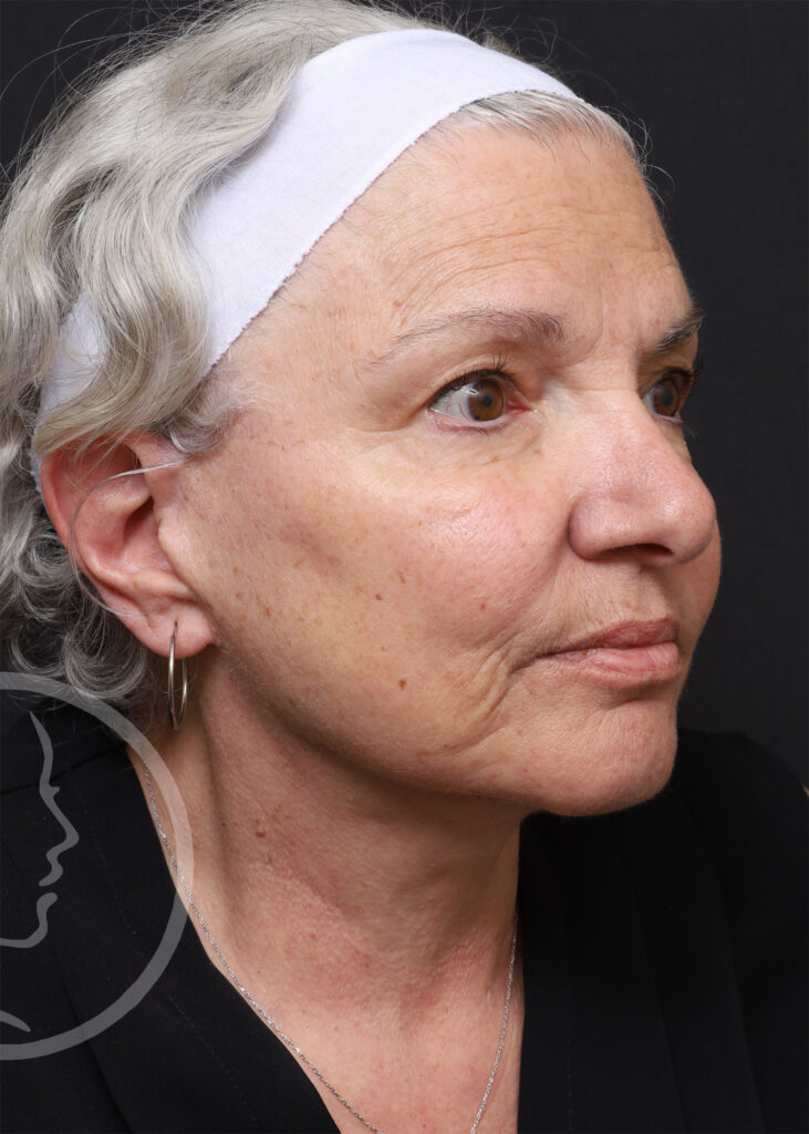 Plastic Surgery Before and After Pictures in Jacksonville, FL - Garcia Facial Plastic Surgery