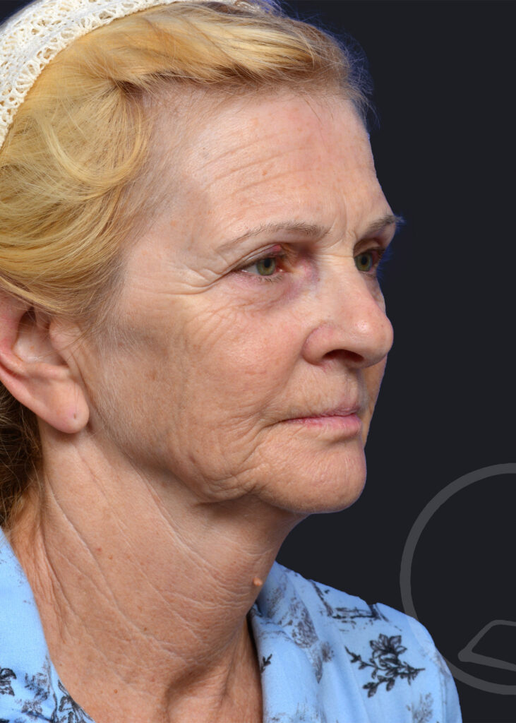 Plastic Surgery Before and After Pictures in Jacksonville, FL - Garcia Facial Plastic Surgery