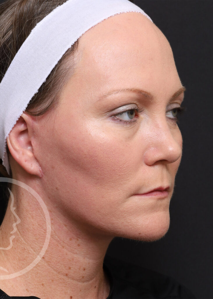 Plastic Surgery Before and After Pictures in Jacksonville, FL - Garcia Facial Plastic Surgery