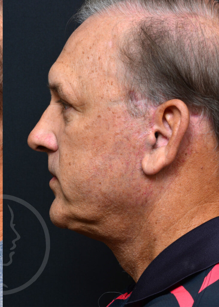 Plastic Surgery Before and After Pictures in Jacksonville, FL - Garcia Facial Plastic Surgery
