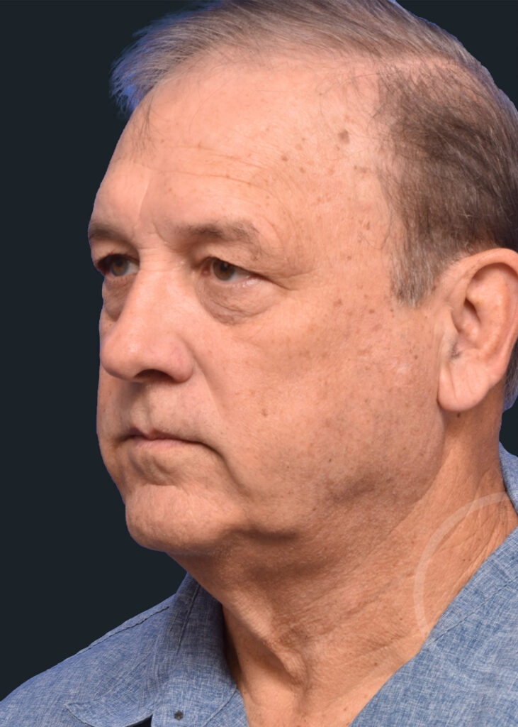 Plastic Surgery Before and After Pictures in Jacksonville, FL - Garcia Facial Plastic Surgery