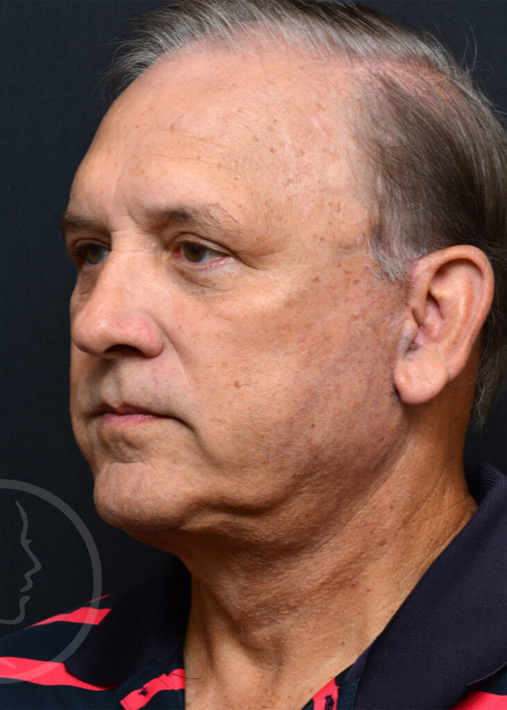 Plastic Surgery Before and After Pictures in Jacksonville, FL - Garcia Facial Plastic Surgery