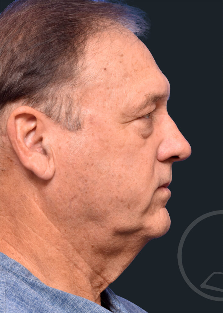 Plastic Surgery Before and After Pictures in Jacksonville, FL - Garcia Facial Plastic Surgery
