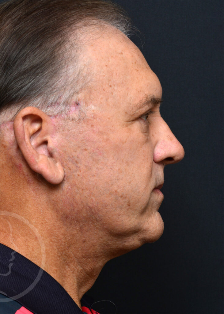 Plastic Surgery Before and After Pictures in Jacksonville, FL - Garcia Facial Plastic Surgery
